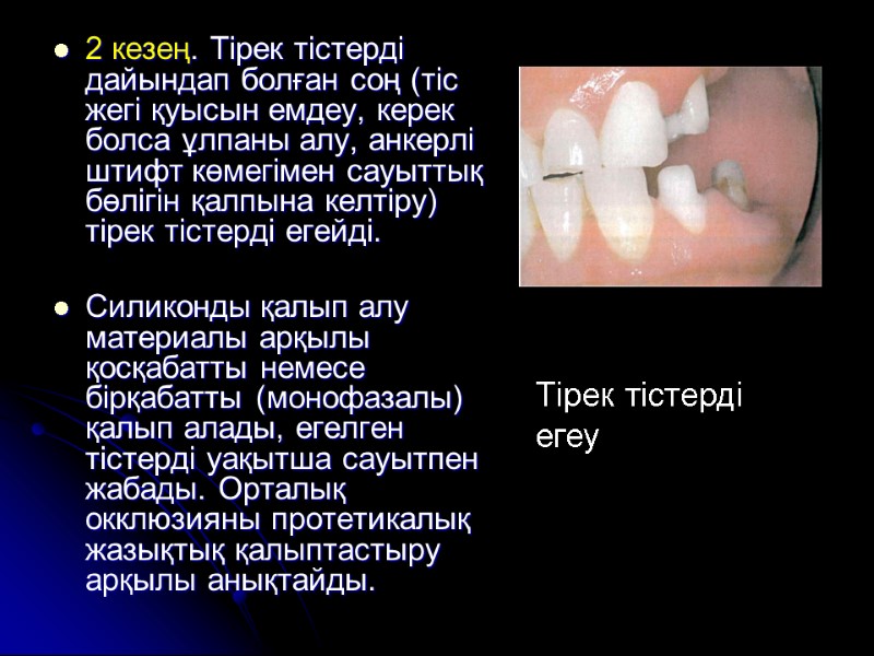 2 кезең. Тірек тістерді дайындап болған соң (тіс жегі қуысын емдеу, керек болса ұлпаны